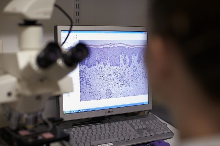 RAFT begins research into new treatments for pathological scarring